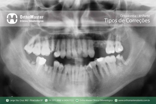 Ortodontia – Avaliação Inicial e Tipos de Correções